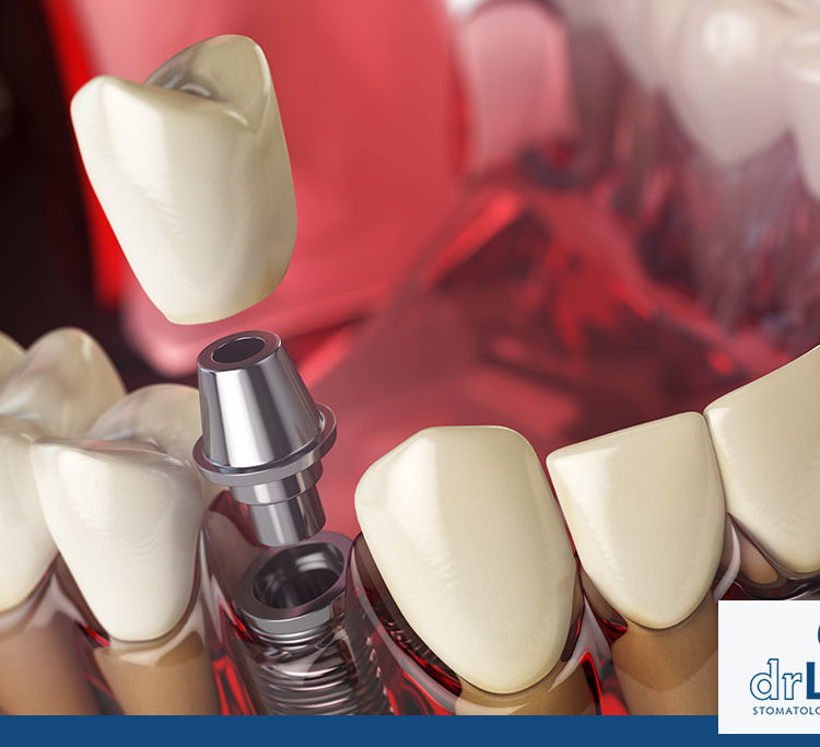 zubni implanti - implantološka ordinacija dr Lolin