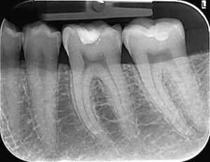 intraoralni snimak, snimanje zuba novi sad, dr lolin stomatološka ordinacija