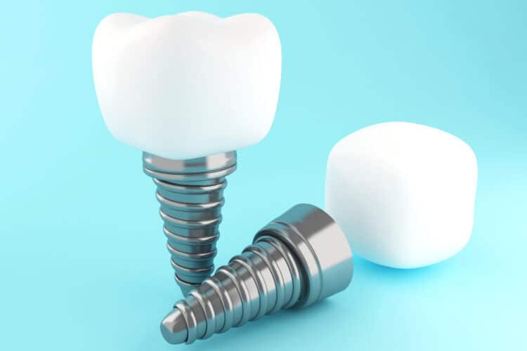 implantologija - zubni implanti dr Lolin