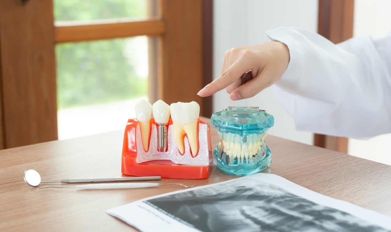 koliko traju zubni implanti - dr lolin implantologija