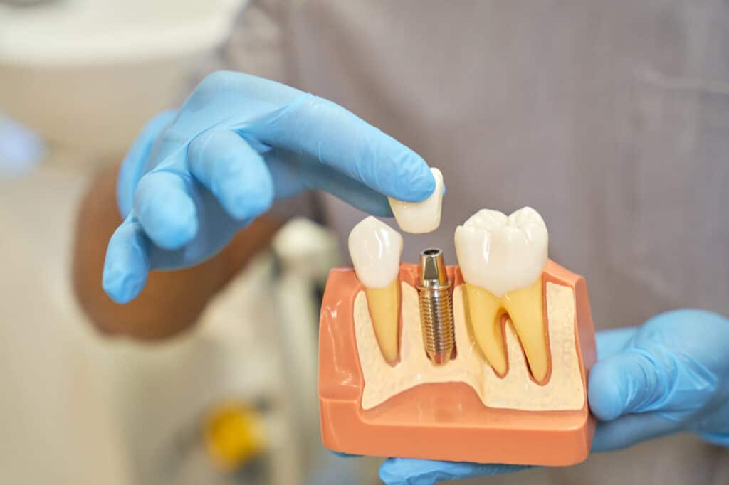 ugradnja implanta - prikaz na modelu vilice - dr lolin implantolog - zubni implanti