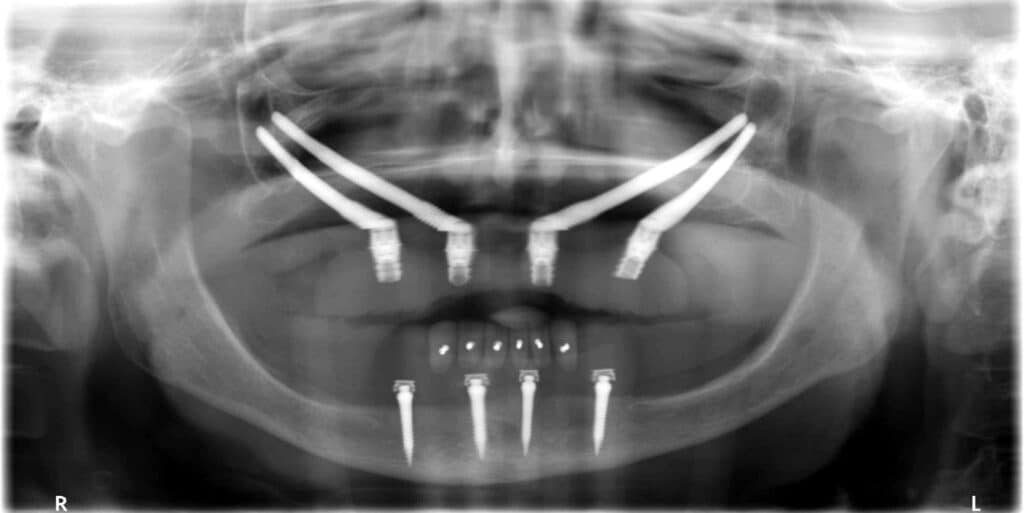 zigomatični implanti ISKUSTVA- dr lolin - snimak - implantologija - zigoma