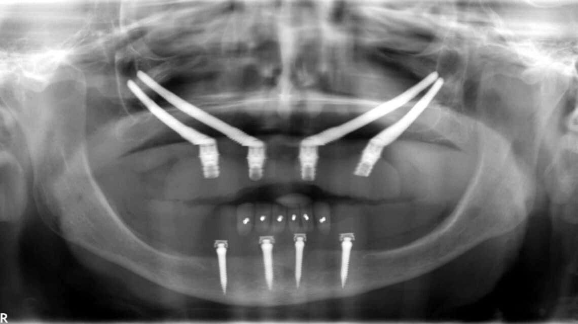 zigomatični implanti ISKUSTVA- dr lolin - snimak - implantologija - zigoma