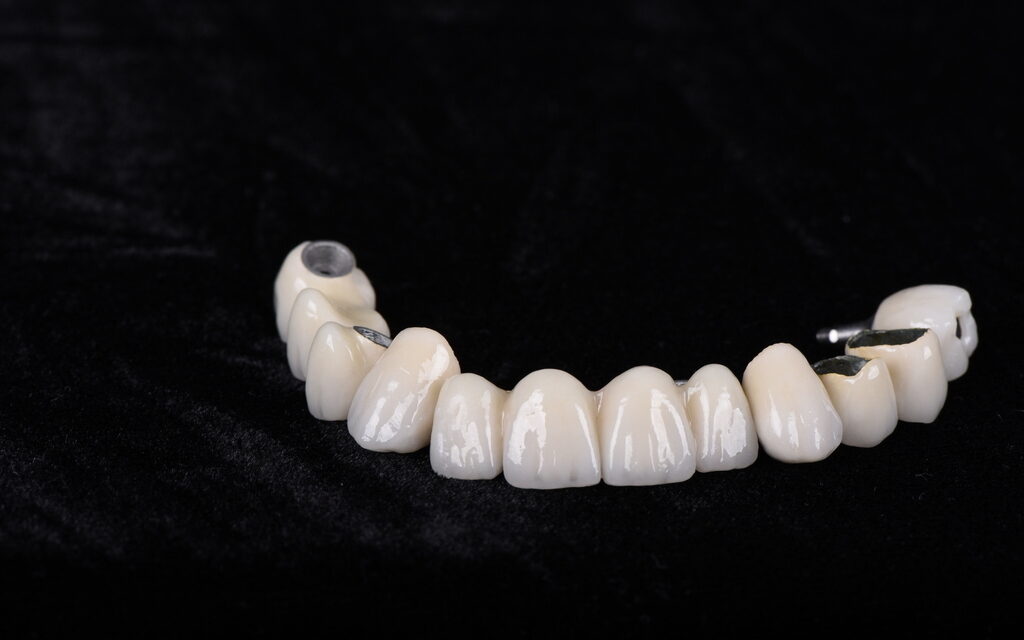 metalokeramicke krunice za zube - B1 boja - Razlika između bezmetalnih i metalokeramičkih krunica