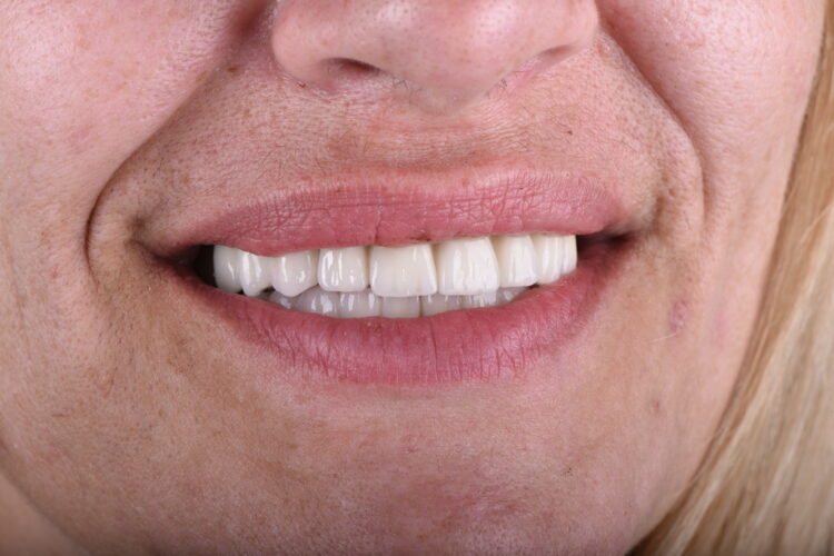 krunice za zube iskustva pacijenata - osmeh posle intervencijee - stomatološka ordinacija dr Lolin