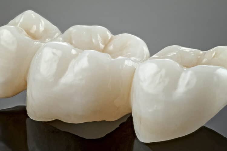 koliko traje zubna krunica - bezmetalne krunica - dr Lolin