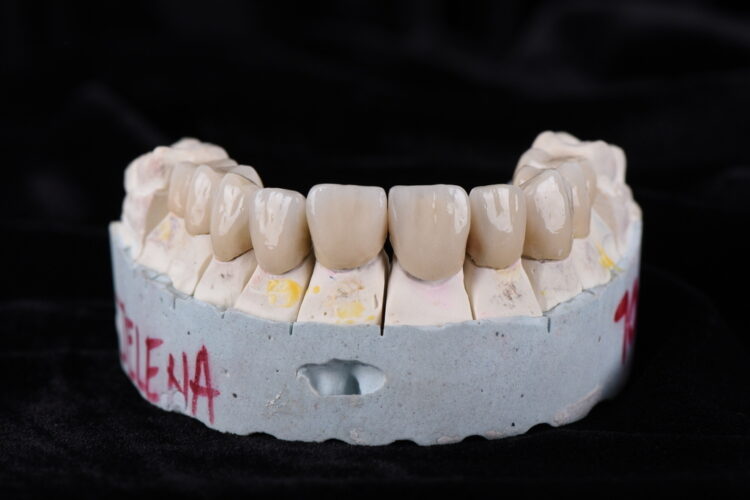 metalokeramičke krunice iskustva - primer rada od pojedinačnih krunica - stomatološka ordinacija dr Lolin