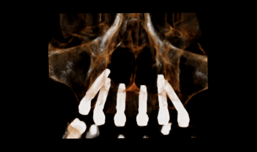 tuber pterigodini zubni implanti - prikaz na 3D snimku - implantološka ordinacija dr Lolin