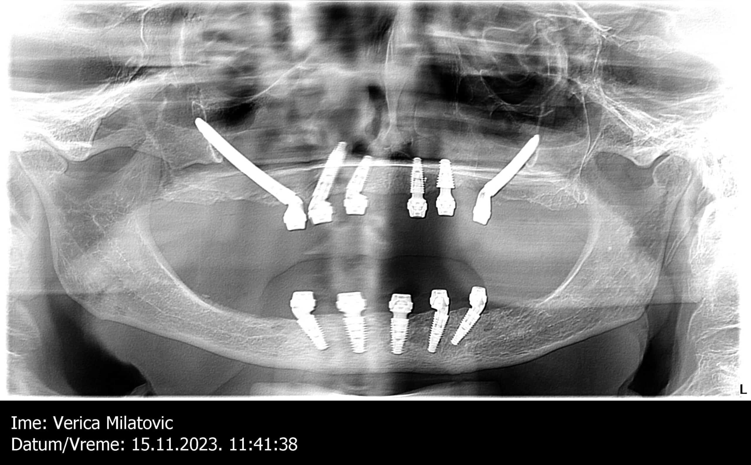zigomaticni implantati
