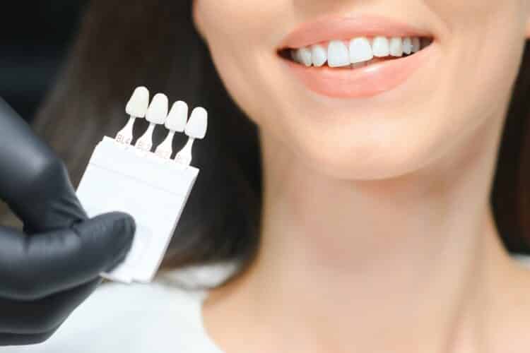 kako se radi hollywood smile prikaz bleach boja zuba - dr Lolin ordinacija
